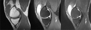 Sagittal MRI