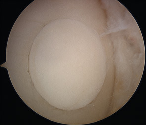 Osteochondral autograft transfer