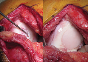 Cartilage defect