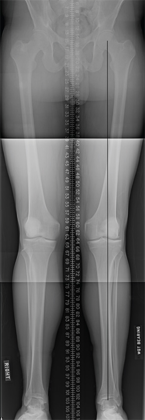 Preoperative long leg alignment
