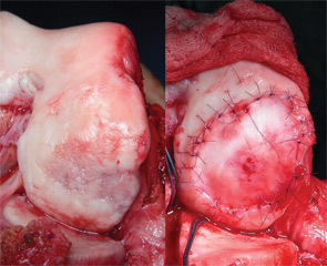 Intraoperative