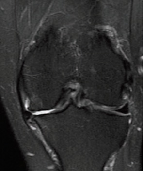 Figure 2A: A 66-year-old female with sudden medial knee pain after squatting in garden. Preoperative MRI showing medial compartment OA and meniscus extrusion.