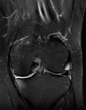 Figure 2B: Postoperative MRI showing decreased bulk of meniscus in medial gutter and less inflammation of medial capsule and MCL. Bone marrow edema is noted in medial tibia and femur.