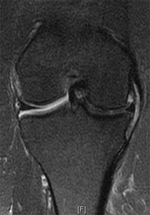 Figure 1: A 44-year-old female with medial meniscus extrusion with mechanical deformation of the medial capsule, MCL bursitis.