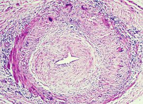 Temporal arteritis is a form of the medium- to large-vessel arteritis named giant cell arteritis.