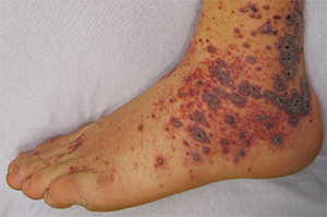 Petechia/purpura on the low limb due to medication induced vasculitis.