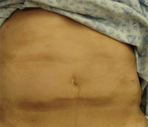 Figure 4. The exam also revealed indurated plaques on the patient's abdomen.