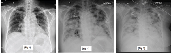 Serial chest X-rays: on the day of admission (Fig. 3), on the third postoperative day (Fig. 4) and on the fourth postoperative day (Fig. 5).