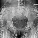 Figure 1: Anteroposterior radiograph of the pelvis.