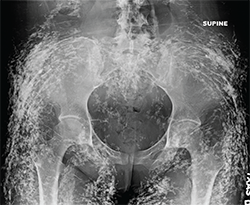 Figure 1: Anteroposterior radiograph of the pelvis.