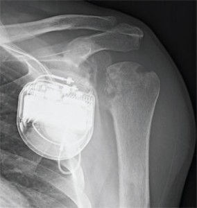 Figure 1: Anteroposterior (AP) radiograph of the left shoulder.