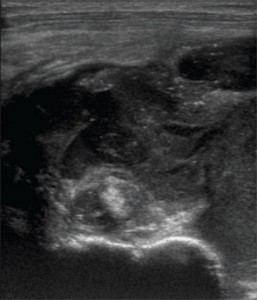 Figure 2: Transverse sonographic image of the left shoulder at the level of the proximal humerus and extra-articular long-head biceps tendon.