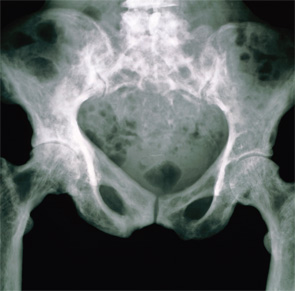 X-ray showing the pelvis of a person with Paget’s disease or osteitis deformans. The pelvic bones have a mottled appearance due to their increased porosity.