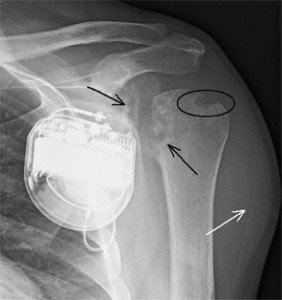 Figure 1: AP radiograph of the left shoulder.
