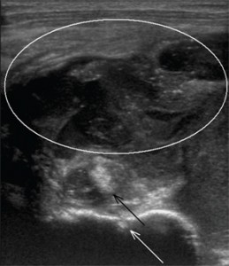 Figure 2: Transverse sonographic image of the left shoulder.