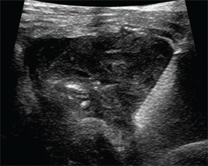 Figure 3: Transverse sonographic image of the left shoulder during aspiration and biopsy.