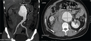 CT-angiography showing ruptured abdominal aortic aneurysm with a retroperitoneal and intraperitoneal hematoma with left renal infarct.