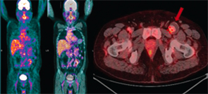 PET-CT showing low to moderate inflammatory activity with aneurismal dilation of the left common femoral artery with thrombus.
