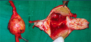Surgical specimen showing aneurismal dilation and thrombus.Surgical specimen showing aneurismal dilation and thrombus.