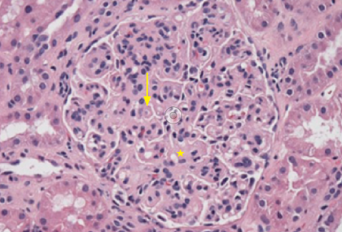Systemic Lupus Erythematosus Without Kidney Involvement A Systemic Lupus Erythematosus Without Kidney Involvement A
