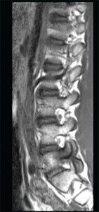 This sagittal T1 weighted MRI image of the lumbar spine shows spondylosis and bone marrowedema within the L5 pedicle extending into the articular facets and lamina.