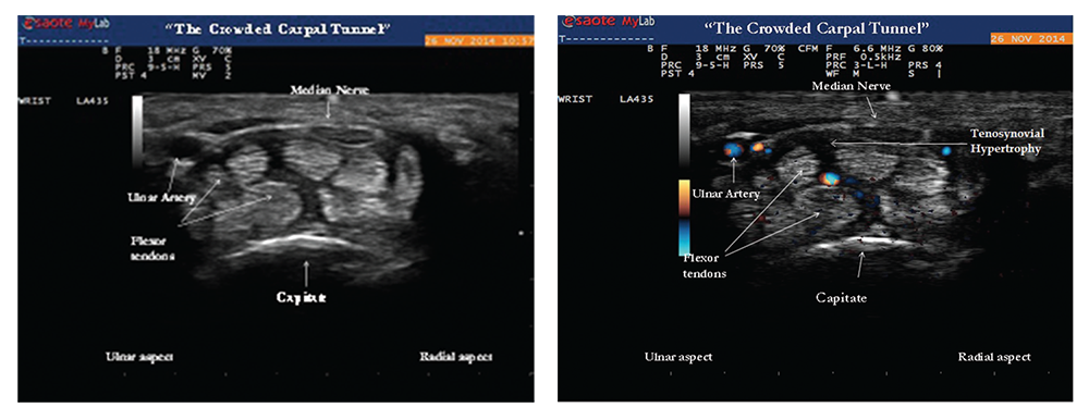 Images 2 & 3: Gray-scale image (left) of the transverse view of the wrist showing tenosynovial hypertrophy within the proximal portion of the carpal tunnel. The hazy dark areas between the flexor tendons represent tenosynovial proliferation with effect of “crowding” the carpal tunnel by increasing perineural median nerve pressure. Doppler ultrasound (right) of the same area reveals positive power Doppler signals between the flexor tendons, an abnormal finding consistent with tenosynovitis.