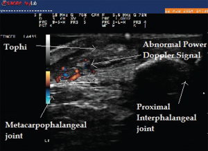 Image 6: Abnormal power Doppler signals suggestive of inflammation and high vascularity in the same patient.