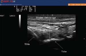 Image 7: Double contour of the tibiotalar joint in the same patient.