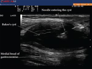 Image 9: The longitudinal view of Baker’s cyst. The medial gastrocnemius muscle is not seen on this view. The needle tip during aspiration using an in-plane technique can be visualized within the cyst.