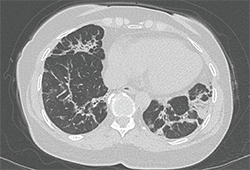 Image 2: The chest CT revealed abnormalities in the bases and lingula, with bilateral mild bronchiectasis, consolidative opacities and fibrosis.