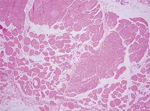 Image 5: Surrounding muscle fibers were variable in size, indicating muscle fiber atrophy secondary to ischemia in the setting of vasculitis.