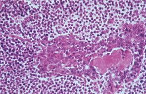 In this patient with Sjögren’s syndrome, most of the parotid gland parenchyma has been replaced by a diffuse collection of lymphocytes, which sometimes leads to an erroneous histologic diagnosis of malignant lymphoma. The lumen of the salivary ductule in the center of the field is occluded by an eosinophilic deposit of inspissated or thickened secretion; the duct lining cells are markedly hyperplastic (epimyoepithelial islands).