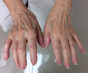 Figure 1A (left) & Figure 1B: These images show the patient’s hands on initial presentation to the rheumatologist, with visible flexion contractures of all digits and swelling, erythema and pain on palpation.