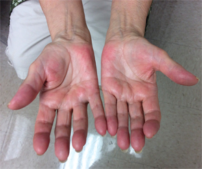 Figure 1A (left) & Figure 1B: These images show the patient’s hands on initial presentation to the rheumatologist, with visible flexion contractures of all digits and swelling, erythema and pain on palpation.