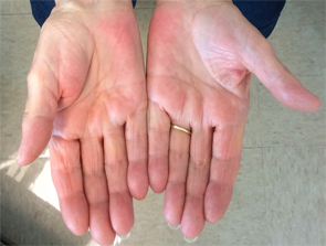 Figure 2A (left) & Figure 2B: These images show the patient’s hands following three months’ treatment with prednisone. The patient has visible improvement of the swelling and contractures and no pain on palpation.