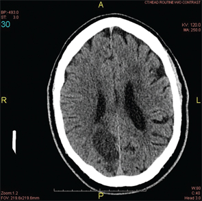 Figure 1: A head CT revealed a subacute infarct involving the right-posterior medial, parietal and occipital lobes.