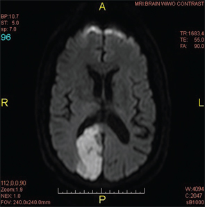 Figure 2A: An MRI of the brain confirmed a subacute infarct involving the right occipito-parietal lobe.