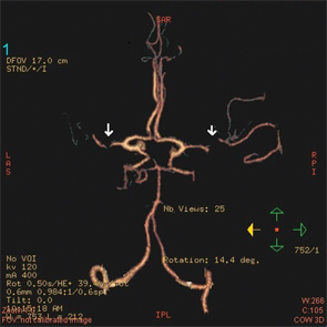 Figure 3: A CT angiogram of the head revealed bilateral MCA stenoses and occlusion of the right posterior cerebral artery.