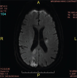 Figure 4: A repeat MRI of the brain two weeks after the initial MRI revealed a new lacunar infarct of the left corona radiata and the old infarct in the right posterior occipito-parietal lobe.