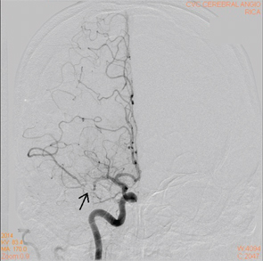 Figure 5A: A cerebral angiogram showing right MCA stenosis.