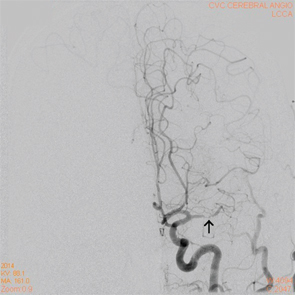 Figure 5B: A cerebral angiogram showing left MCA stenosis.