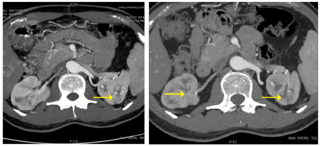(click for larger image)Figure 3: Pretreatment, multiple bilateral intra-renal aneurysms are present.Figure 4: Post-treatment, significant resolution of the aneurysms bilaterally is apparent.
