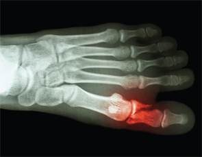 Spontaneous bone fracture is becoming well recognized following the report of 27 spontaneous metatarsal fractures by Dr. Shirish Sangle in APS patients.