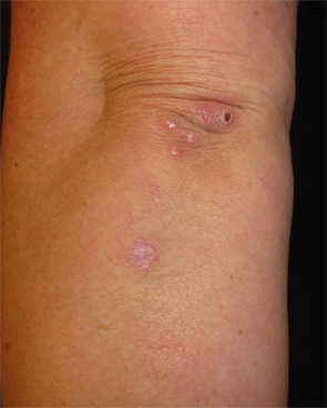 Figure 1: Erythematous, crusted papules and plaques clustered on the left elbow and extensor forearm.