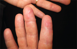 Figure 2: Umbilicated and crusted papules on the volar aspects of the fingers and distal interphalangeal joints.