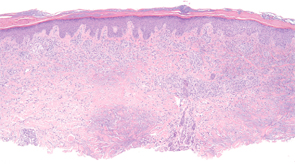 Figure 3: Histopathologic examination of palisaded neutrophilic and granulomatous dermatitis (PNGD) reveals a superficial and mid-dermal collection of histiocytes, with foci of palisading granulomas. (Hematoxylin-eosin stain; original magnification: x40.) Photomicrograph courtesy of Timothy McCalmont, MD.