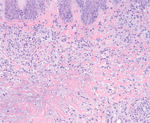 Figure 4: Higher magnification demonstrates aggregates of neutrophils and an interstitial arrangement of histiocytes. (Hematoxylin-eosin stain; original magnification: x400.) Photomicrograph courtesy of Timothy McCalmont, MD.