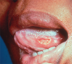 A large, deep, painful ulceration is present on the lateral margin of the tongue in this patient with Behçet’s syndrome.