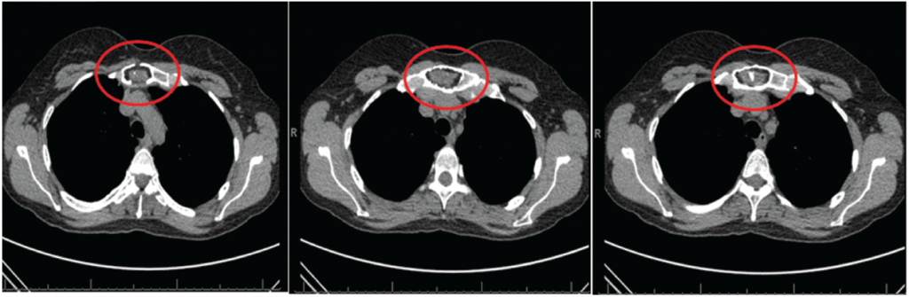 Figure 1: CT scan of the chest with three sagittal sections revealing no evidence of interstitial lung disease or air trapping. Focal lytic lesion in the manubrium (circle) with cortical destruction/defect and internal soft tissue component.