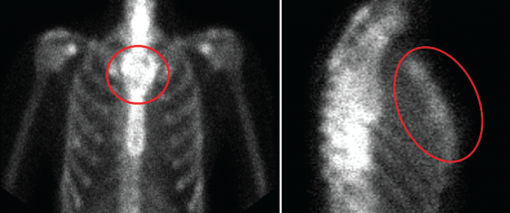 Figure 2: Whole-body bone scan revealing irregular, expanded appearance of the manubrium, which correlates with the lytic lesion seen on recent chest CT with no foci of increased radiotracer activity to suggest osseous metastatic disease.